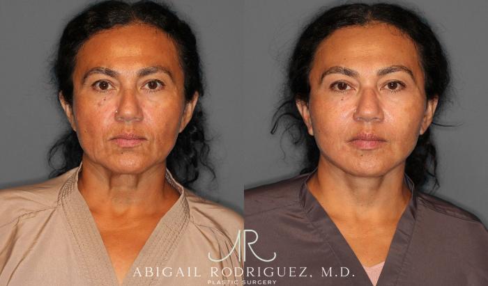 Before & After Facelift Case 258387 View 1 View in Houston, TX