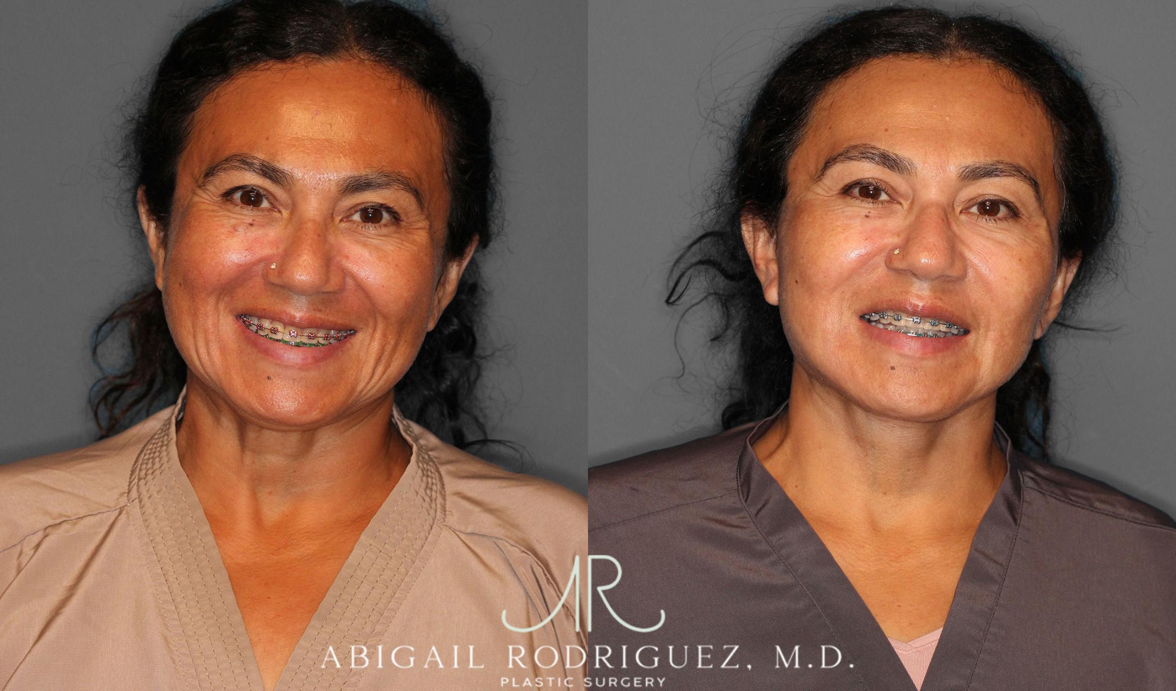 Before & After Facelift Case 258387 View 2 View in Houston, TX