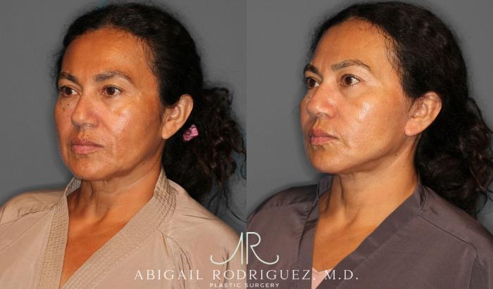 Before & After Facelift Case 258387 View 3 View in Houston, TX
