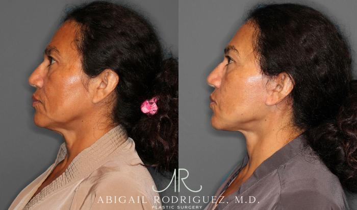 Before & After Facelift Case 258387 View 4 View in Houston, TX
