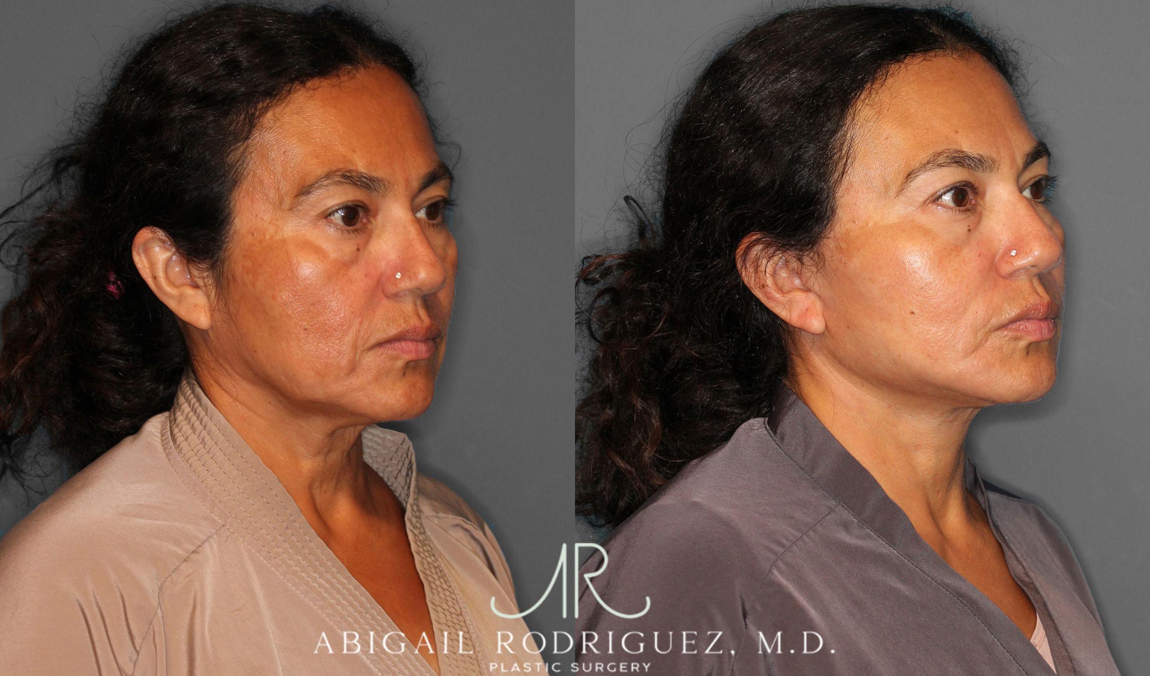 Before & After Facelift Case 258387 View 5 View in Houston, TX