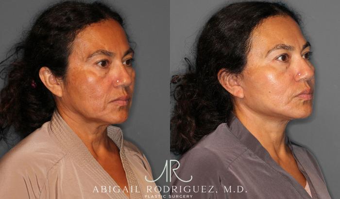 Before & After Facelift Case 258387 View 5 View in Houston, TX