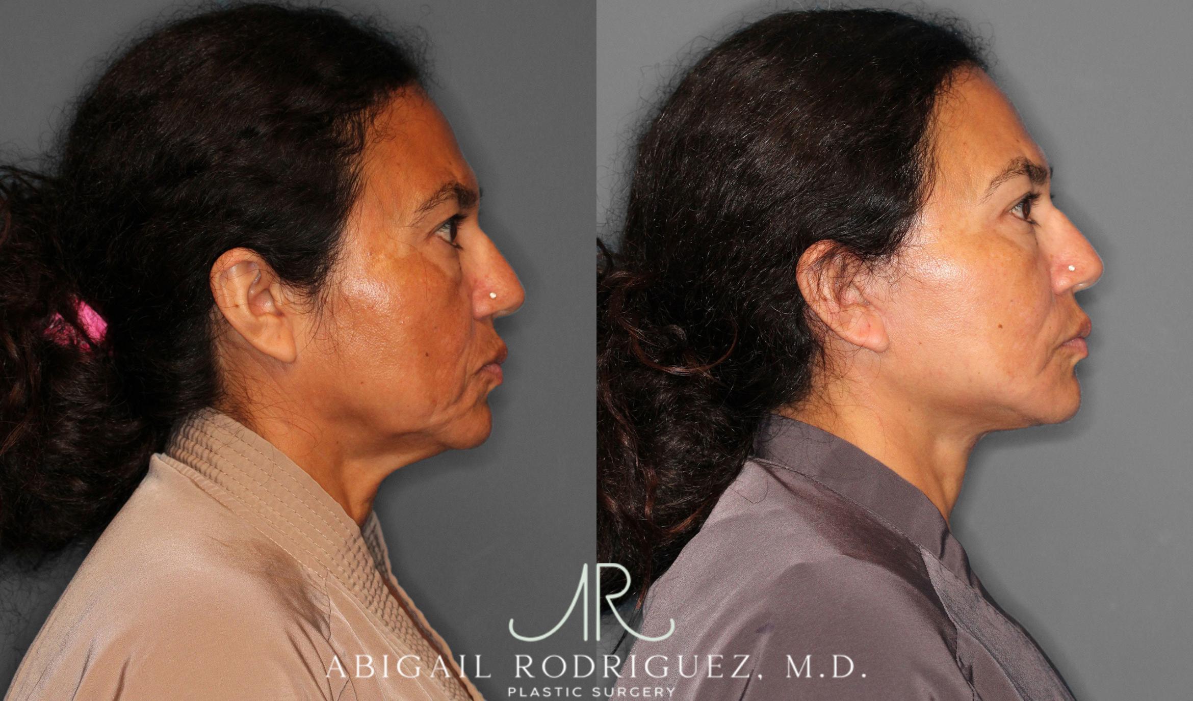 Before & After Facelift Case 258387 View 6 View in Houston, TX