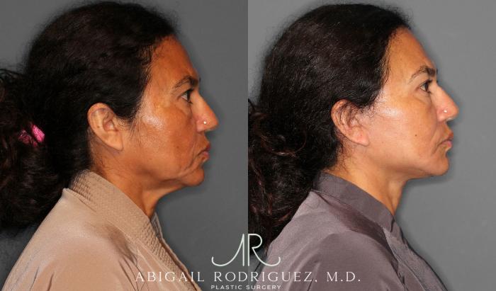 Before & After Facelift Case 258387 View 6 View in Houston, TX