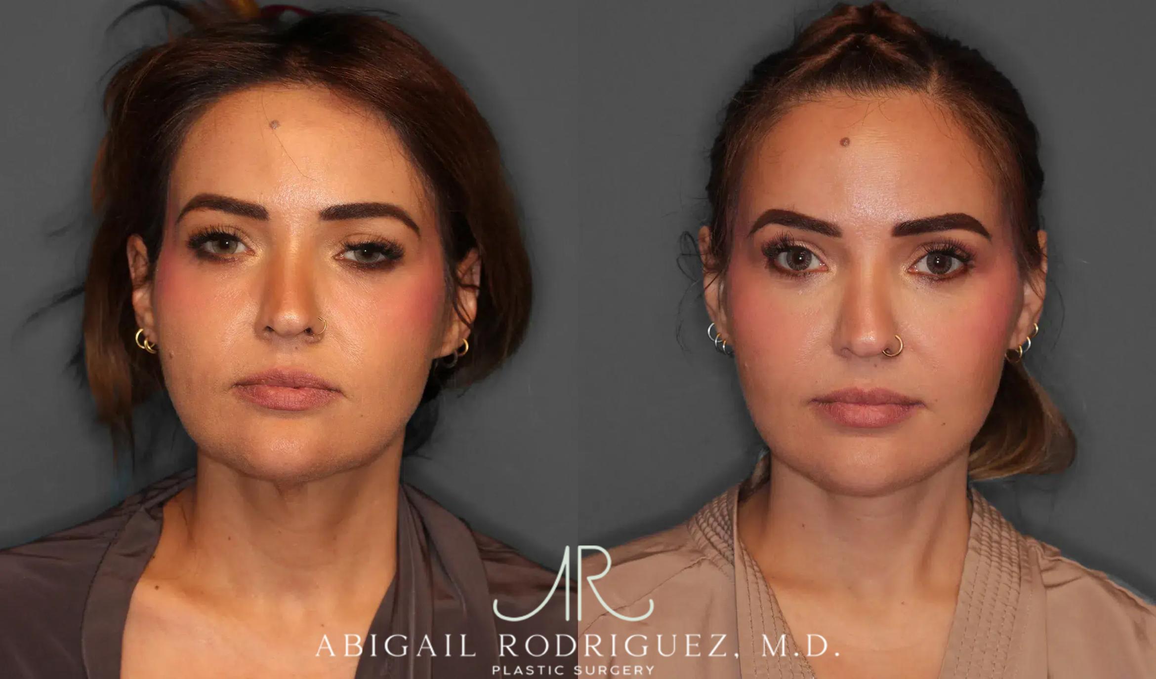 Before & After Facelift Case 259312 View 1 View in Houston, TX