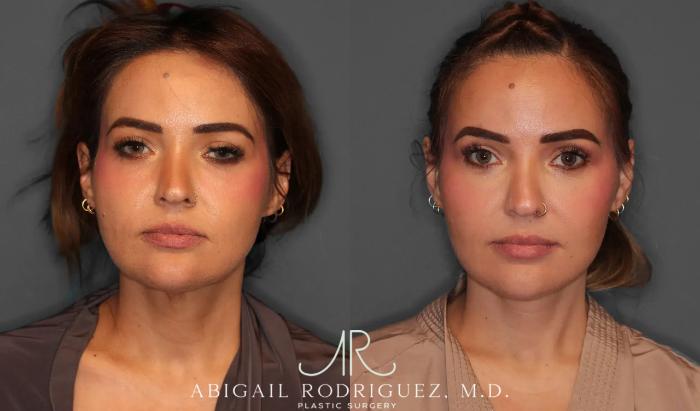 Before & After Facelift Case 259312 View 1 View in Houston, TX