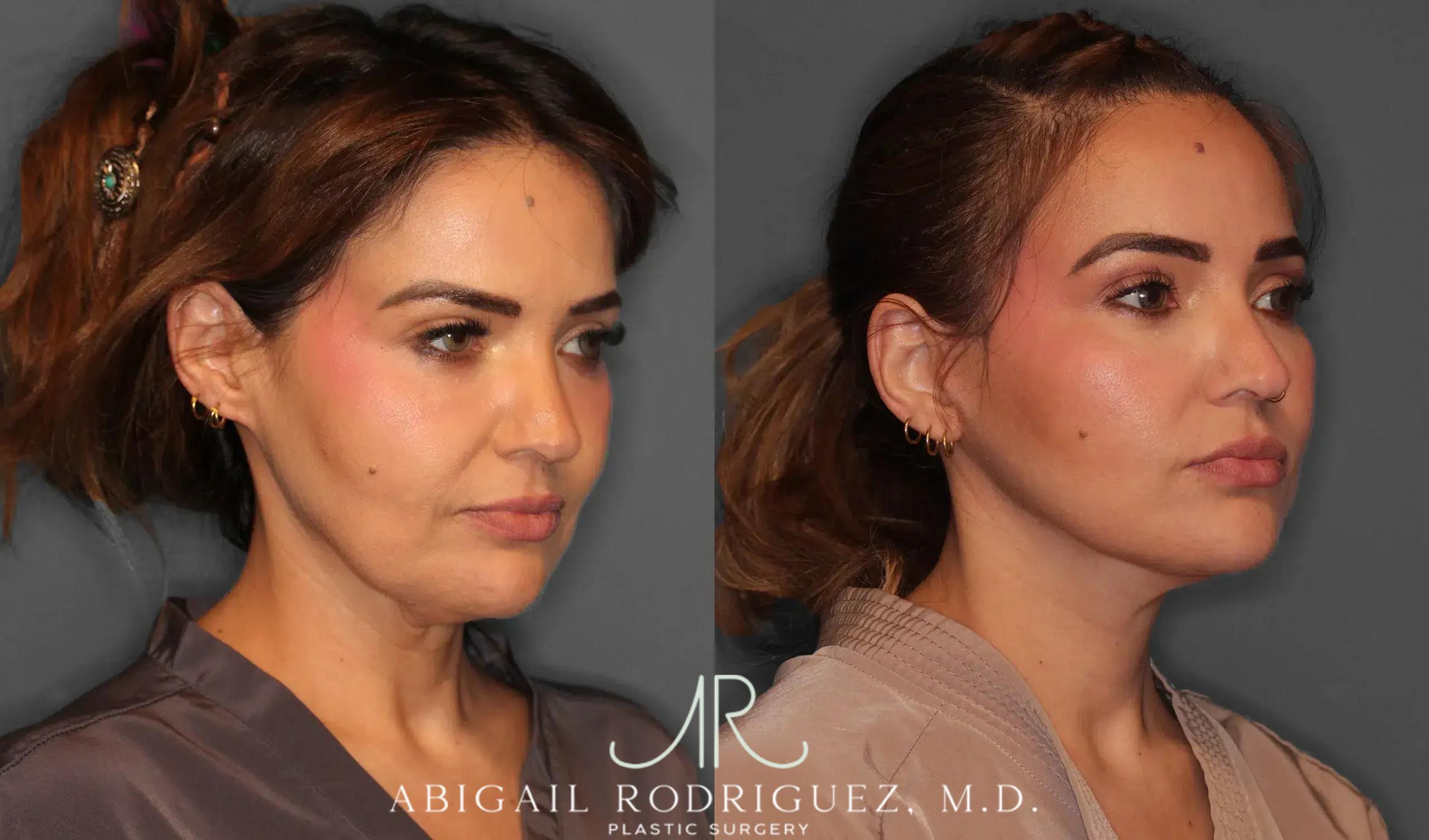 Before & After Facelift Case 259312 View 2 View in Houston, TX