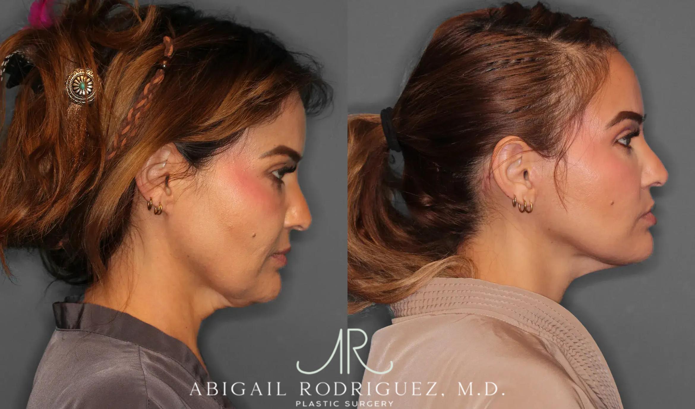 Before & After Facelift Case 259312 View 3 View in Houston, TX