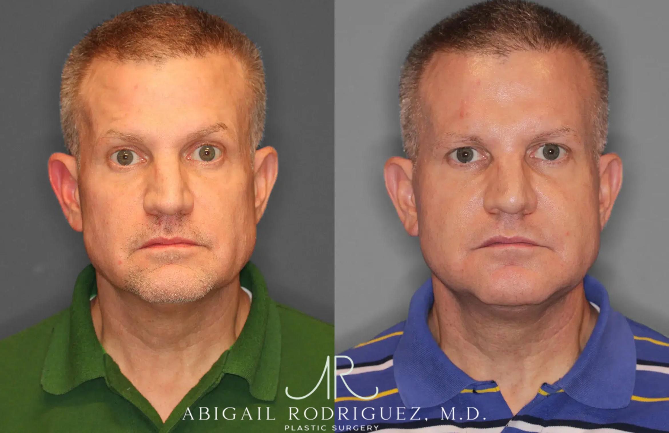 Before & After Facelift Case 259521 View 1 View in Houston, TX