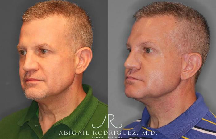 Before & After Facelift Case 259521 View 2 View in Houston, TX