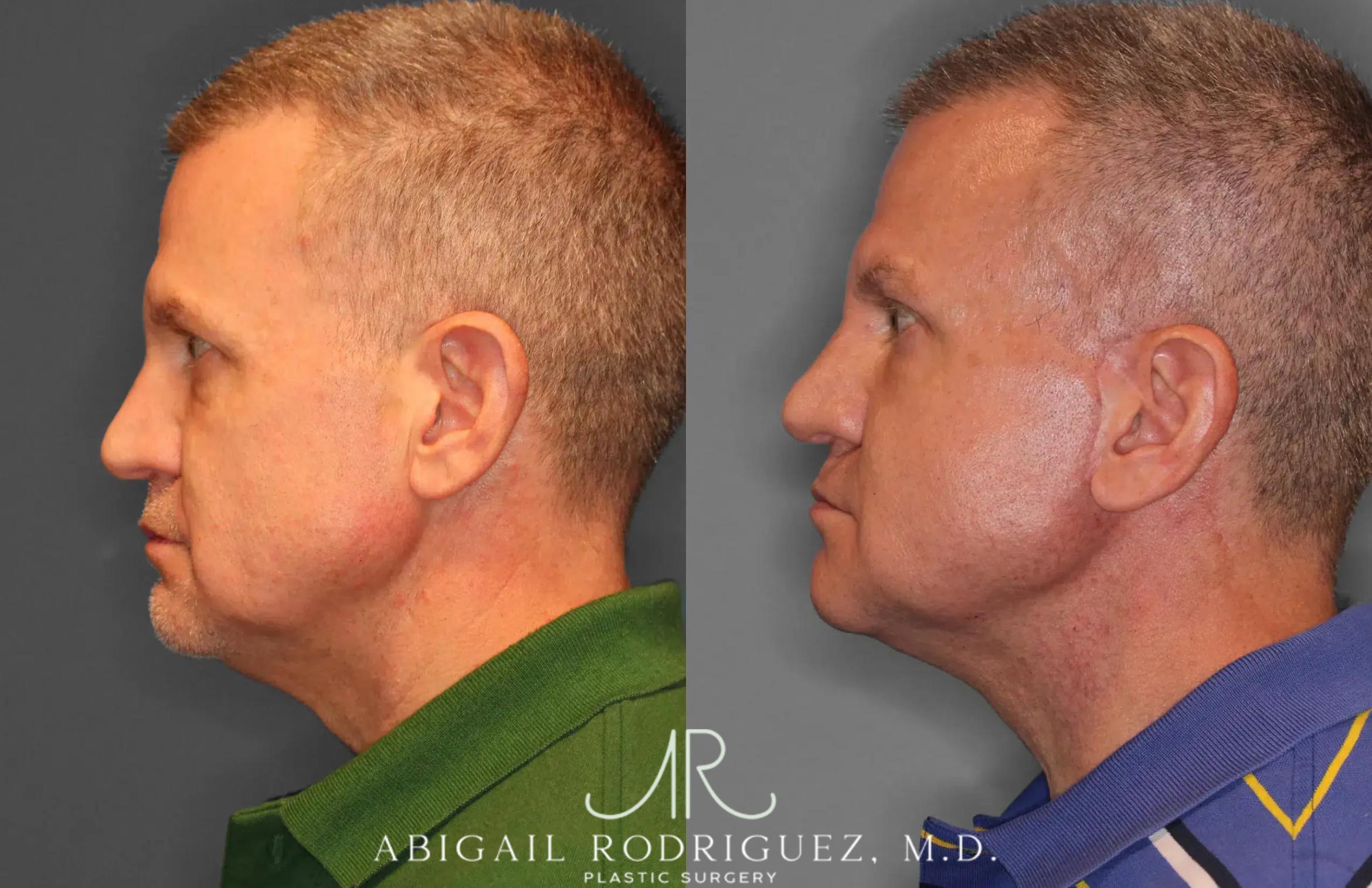 Before & After Facelift Case 259521 View 3 View in Houston, TX