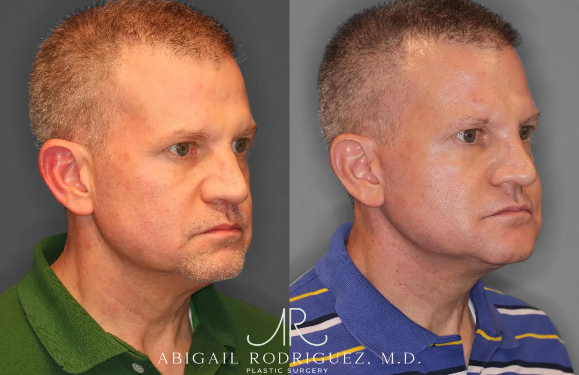 Before & After Facelift Case 259521 View 4 View in Houston, TX