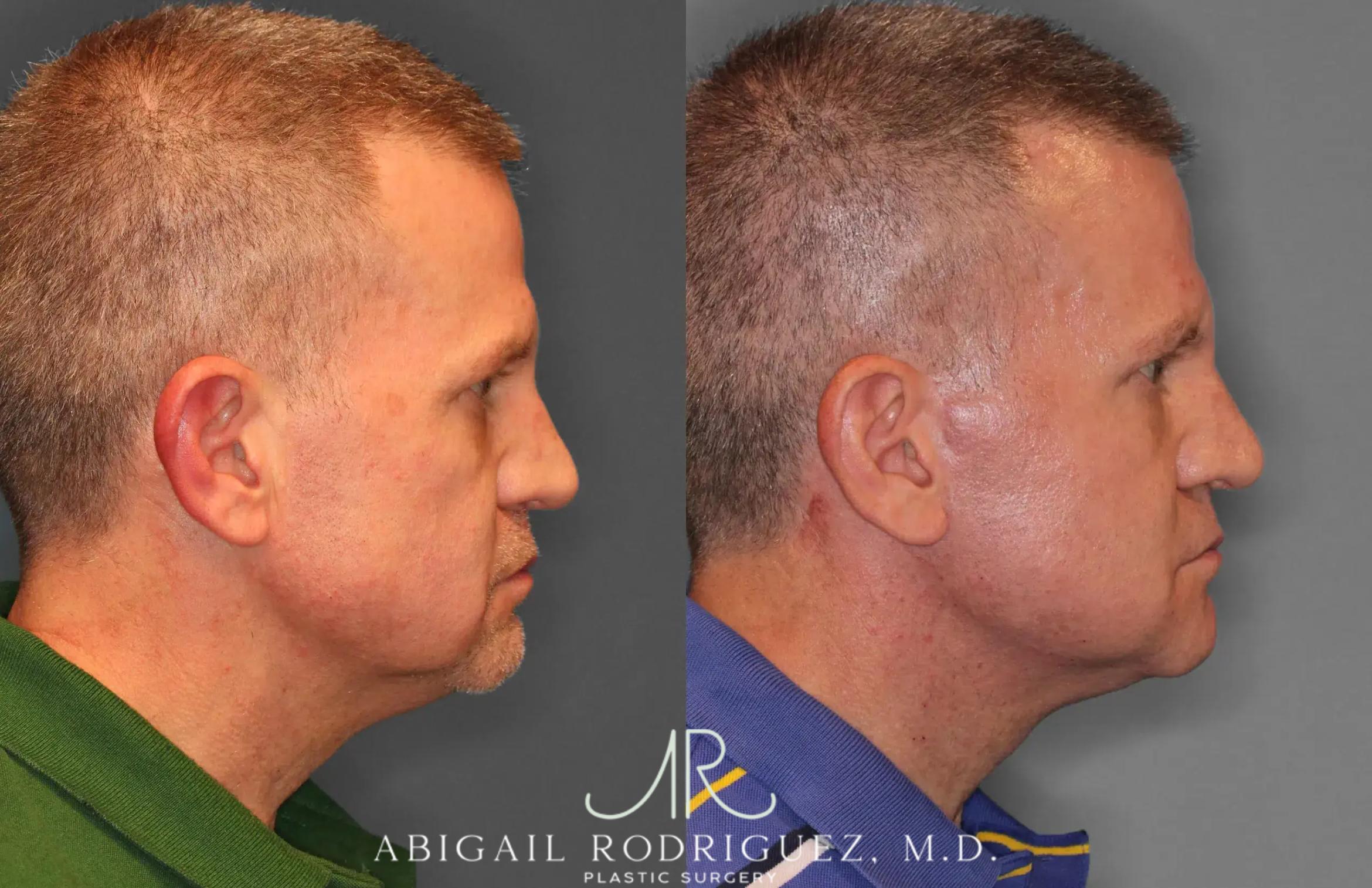 Before & After Facelift Case 259521 View 5 View in Houston, TX