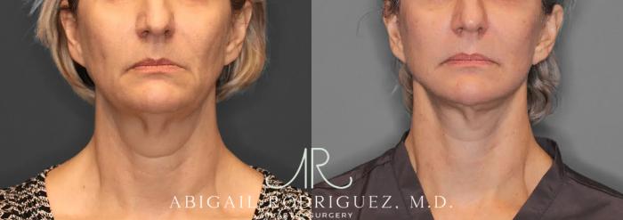 Before & After Facelift Case 259580 View 1 View in Houston, TX