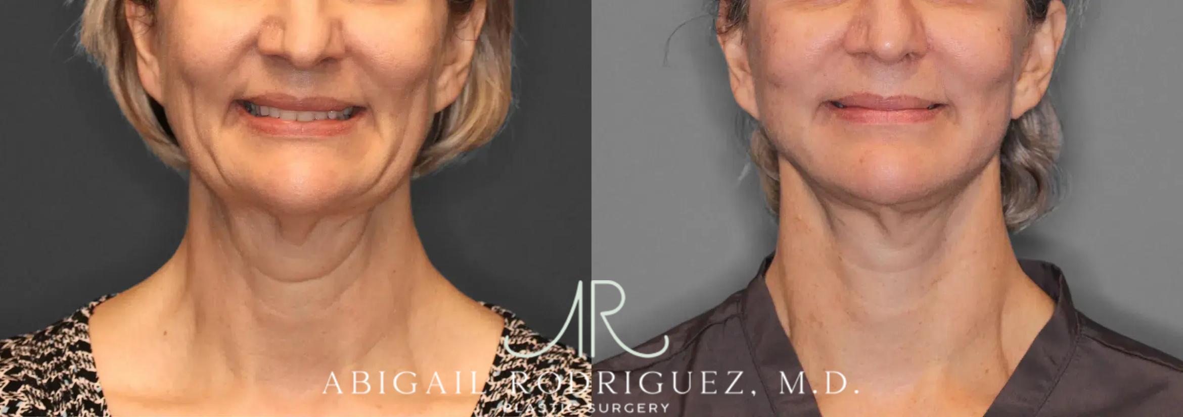 Before & After Facelift Case 259580 View 2 View in Houston, TX
