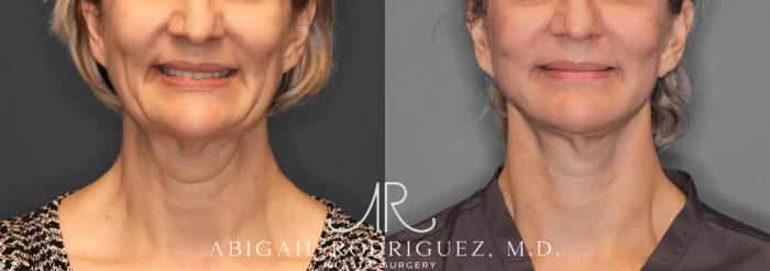 Before & After Facelift Case 259580 View 2 View in Houston, TX