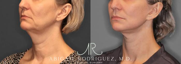 Before & After Facelift Case 259580 View 3 View in Houston, TX