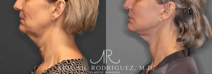 Before & After Facelift Case 259580 View 4 View in Houston, TX