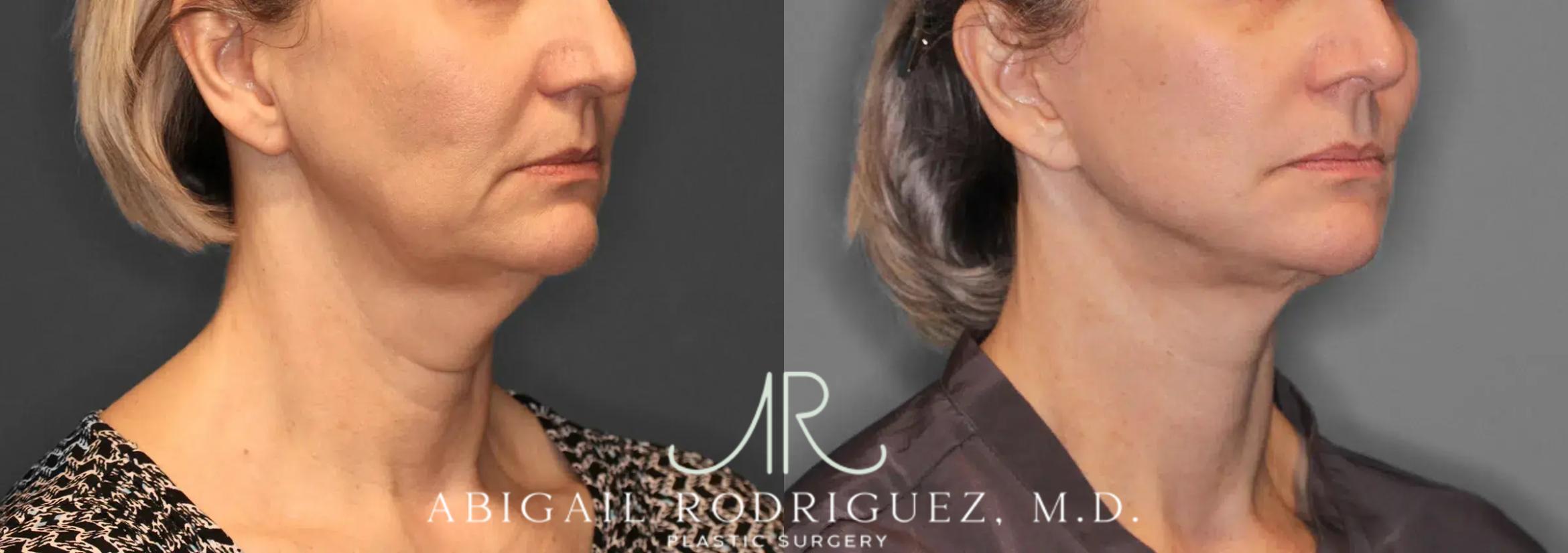 Before & After Facelift Case 259580 View 5 View in Houston, TX