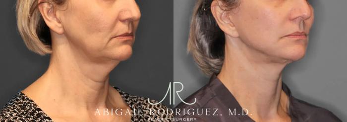 Before & After Facelift Case 259580 View 5 View in Houston, TX