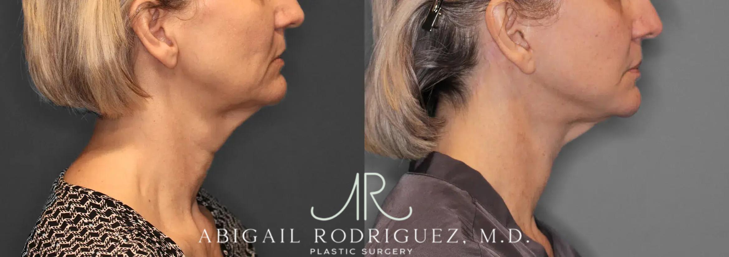 Before & After Facelift Case 259580 View 6 View in Houston, TX