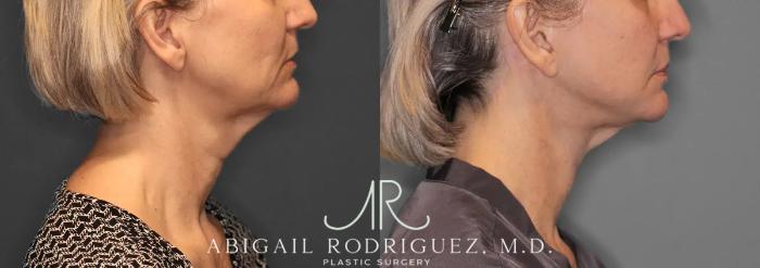 Before & After Facelift Case 259580 View 6 View in Houston, TX