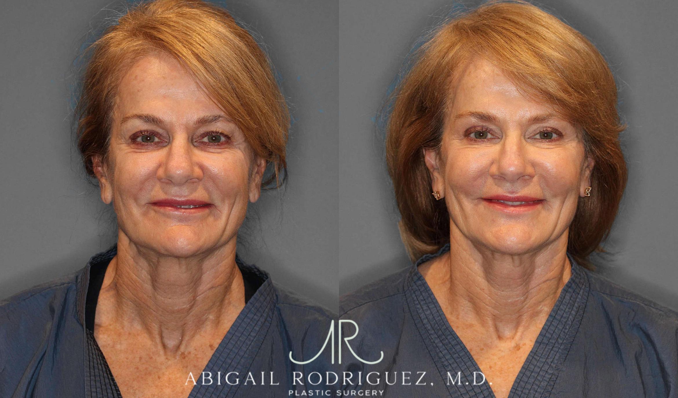 Before & After Facial Fat Grafting Case 254912 View 1 View in Houston, TX