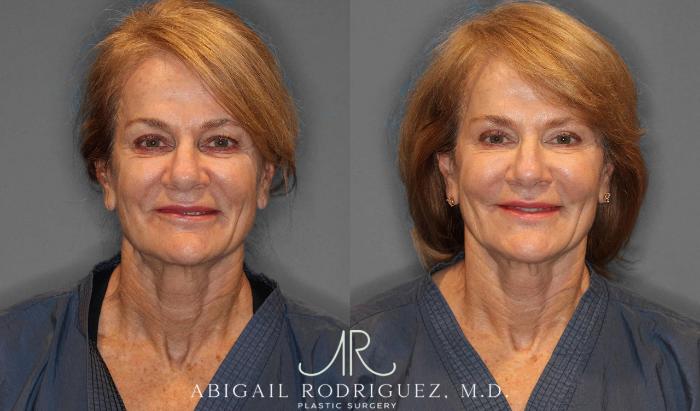 Before & After Facial Fat Grafting Case 254912 View 1 View in Houston, TX
