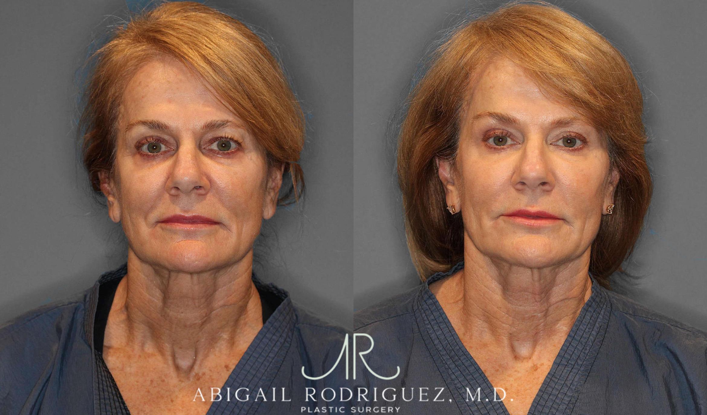 Before & After Facial Fat Grafting Case 254912 View 2 View in Houston, TX