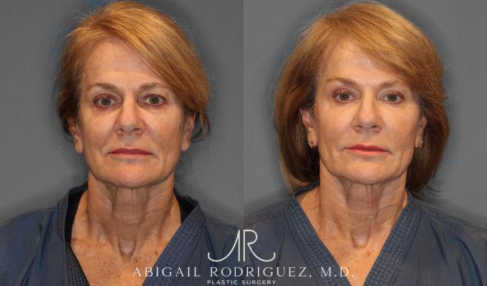Before & After Facial Fat Grafting Case 254912 View 2 View in Houston, TX