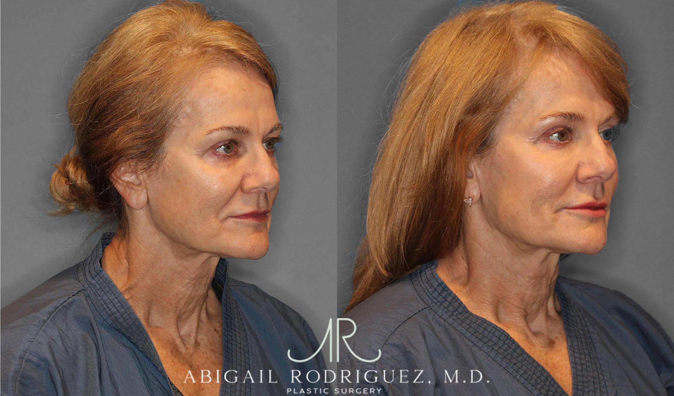 Before & After Facial Fat Grafting Case 254912 View 3 View in Houston, TX