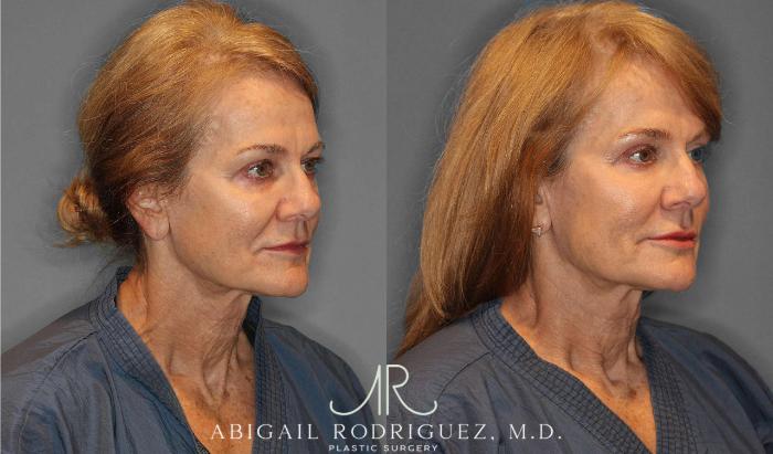 Before & After Facial Fat Grafting Case 254912 View 3 View in Houston, TX