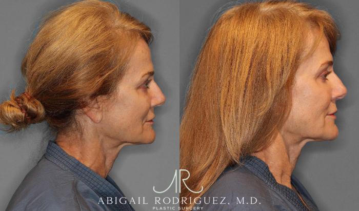 Before & After Facial Fat Grafting Case 254912 View 4 View in Houston, TX