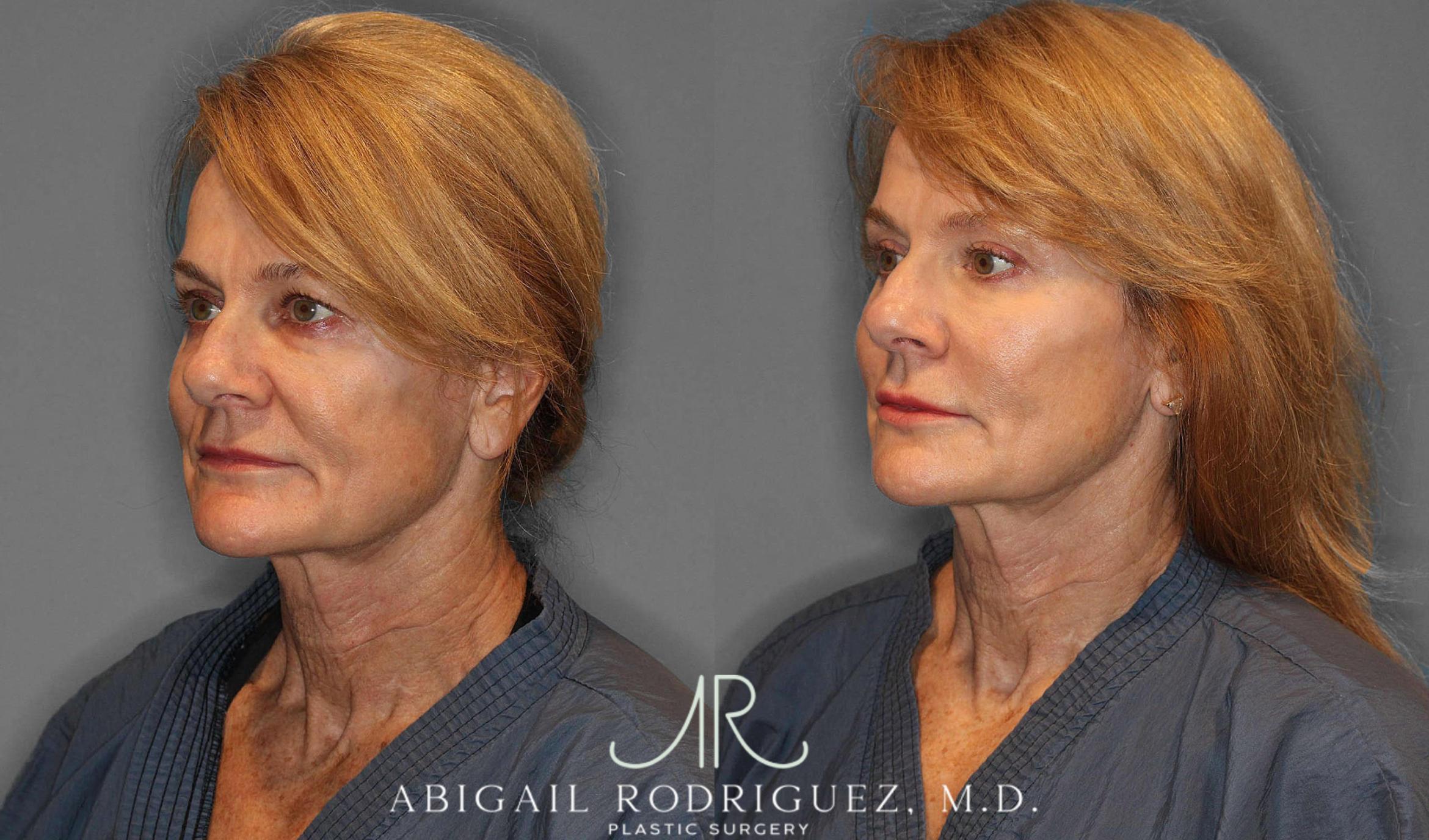 Before & After Facial Fat Grafting Case 254912 View 5 View in Houston, TX