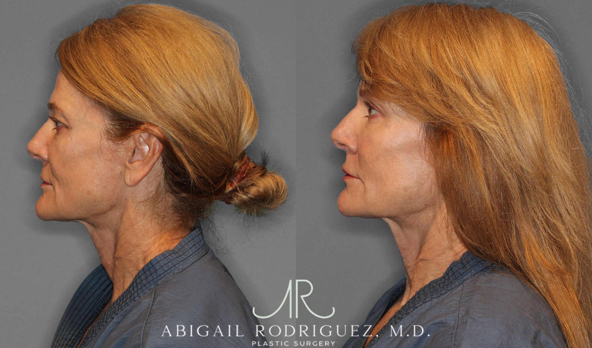 Before & After Facial Fat Grafting Case 254912 View 6 View in Houston, TX