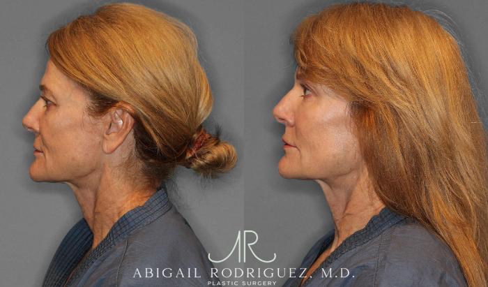 Before & After Facial Fat Grafting Case 254912 View 6 View in Houston, TX