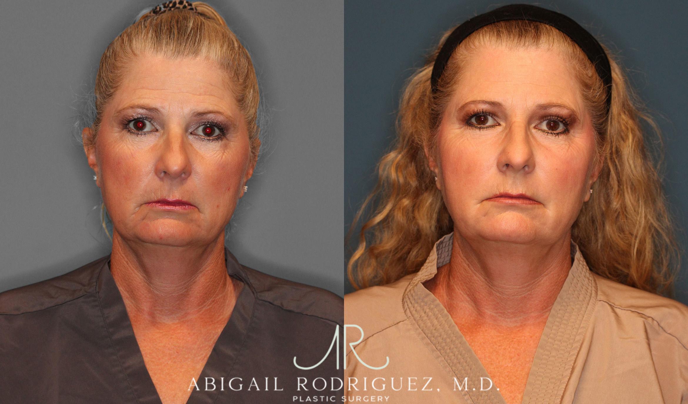 Before & After Facial Fat Grafting Case 258047 View 1 View in Houston, TX
