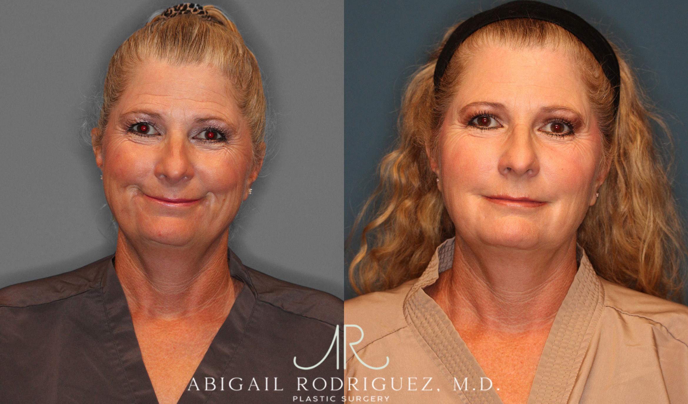 Before & After Facial Fat Grafting Case 258047 View 2 View in Houston, TX