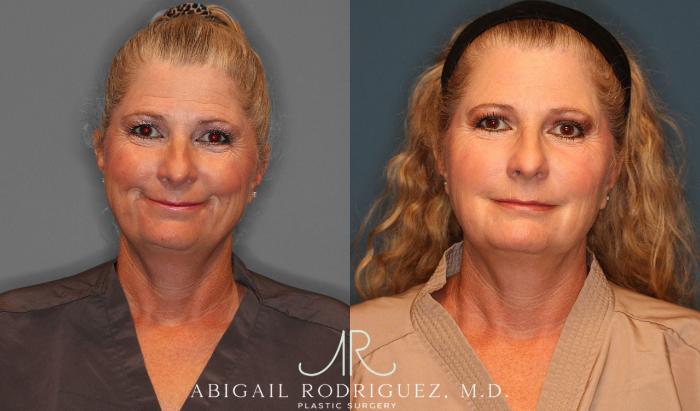Before & After Facial Fat Grafting Case 258047 View 2 View in Houston, TX
