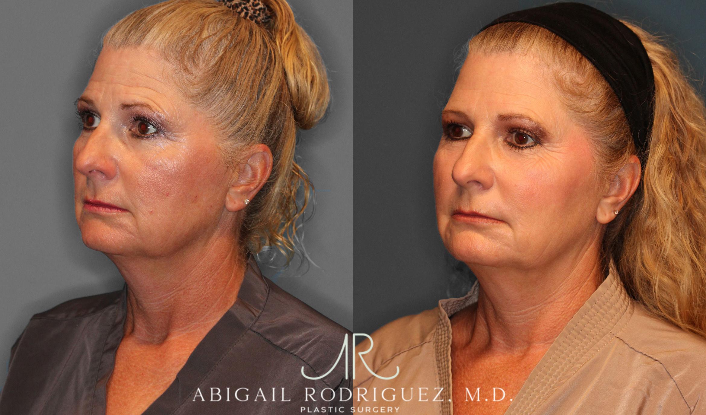 Before & After Facial Fat Grafting Case 258047 View 3 View in Houston, TX