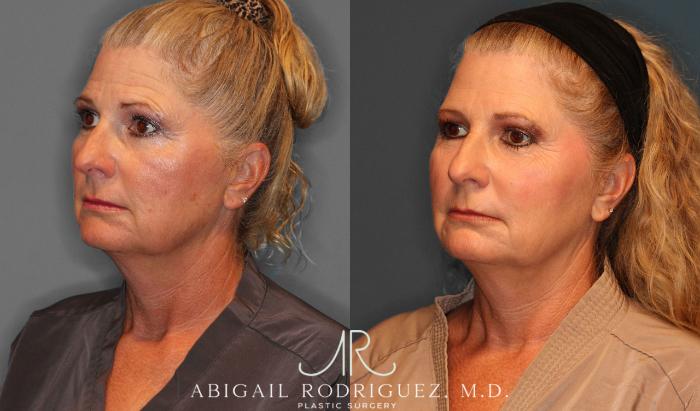 Before & After Facial Fat Grafting Case 258047 View 3 View in Houston, TX