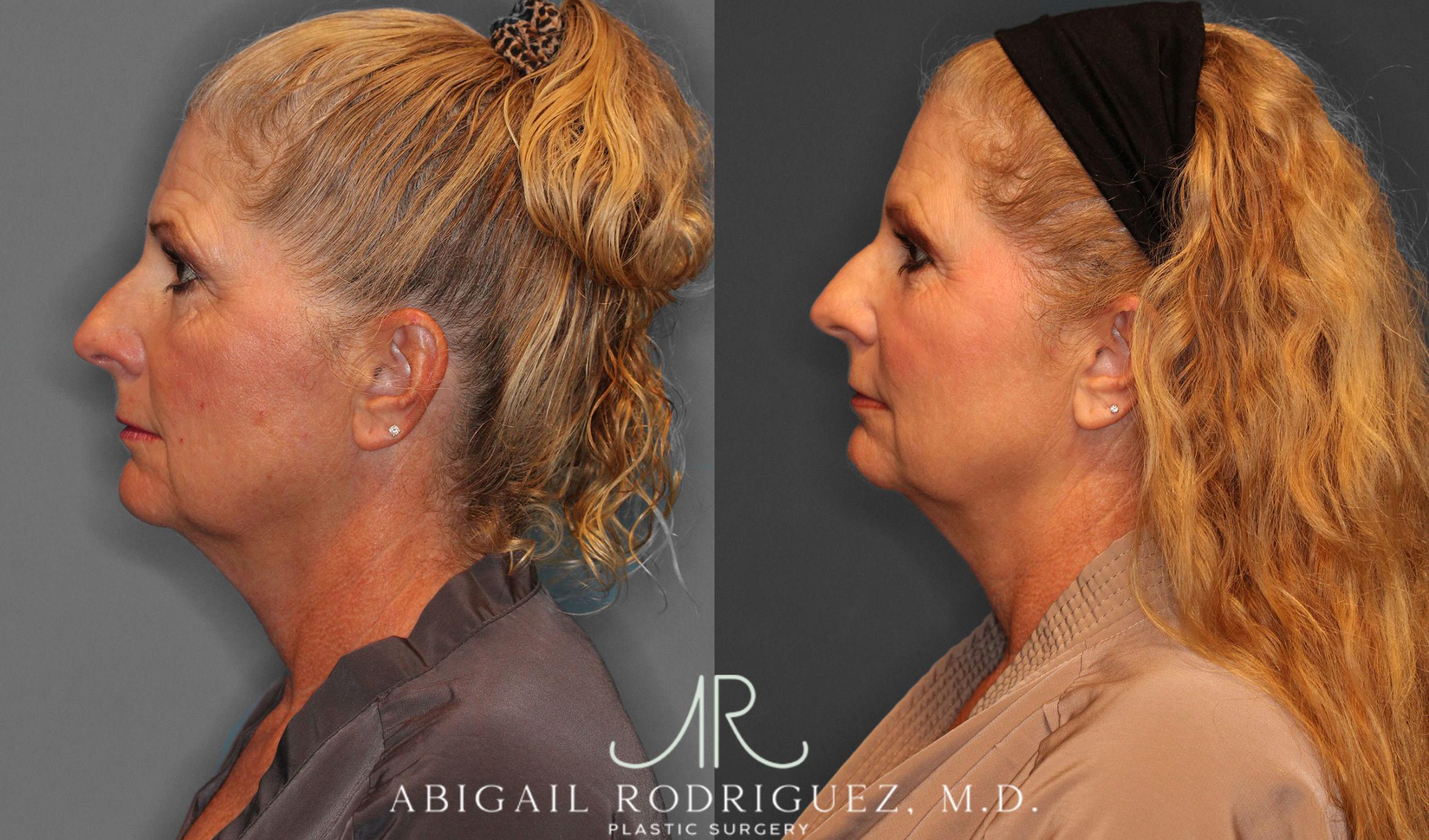 Before & After Facial Fat Grafting Case 258047 View 4 View in Houston, TX