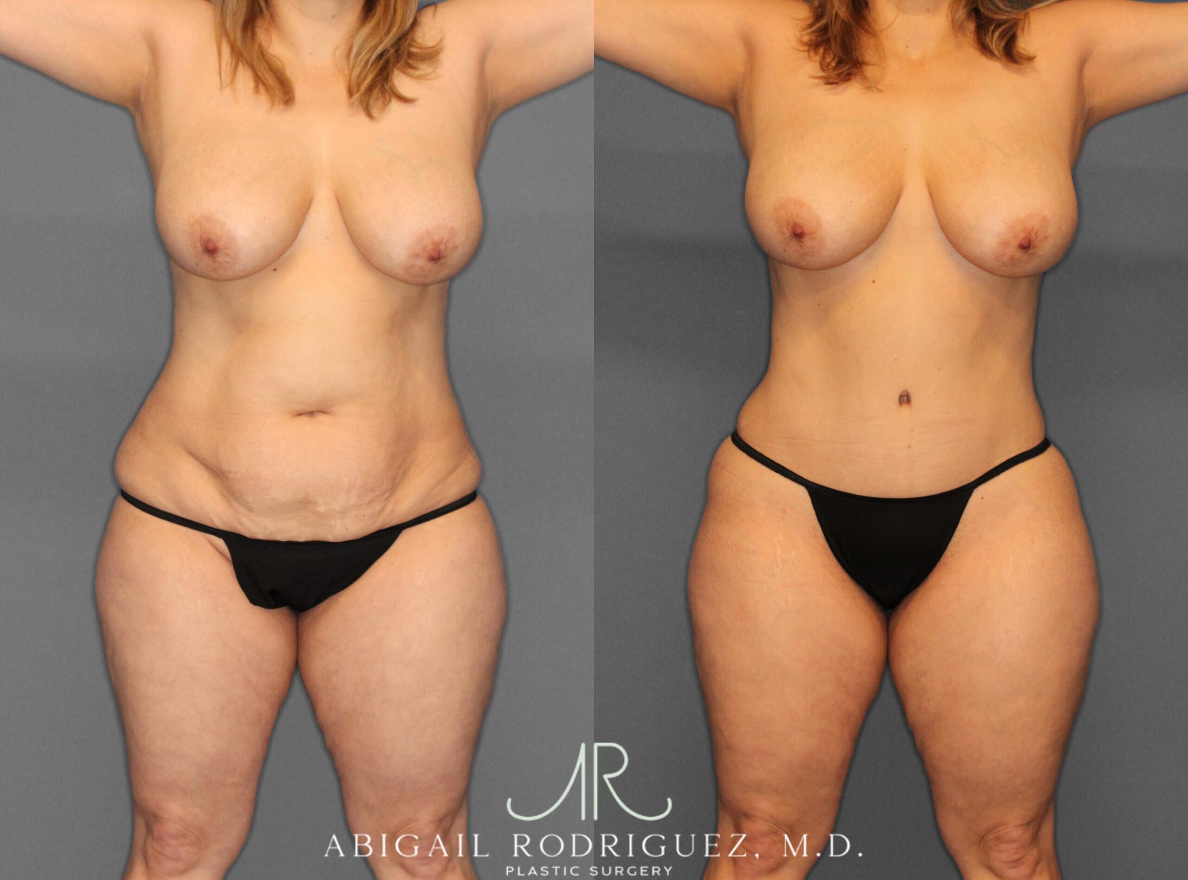 Before & After Fat Grafting Case 253931 View 1 View in Houston, TX