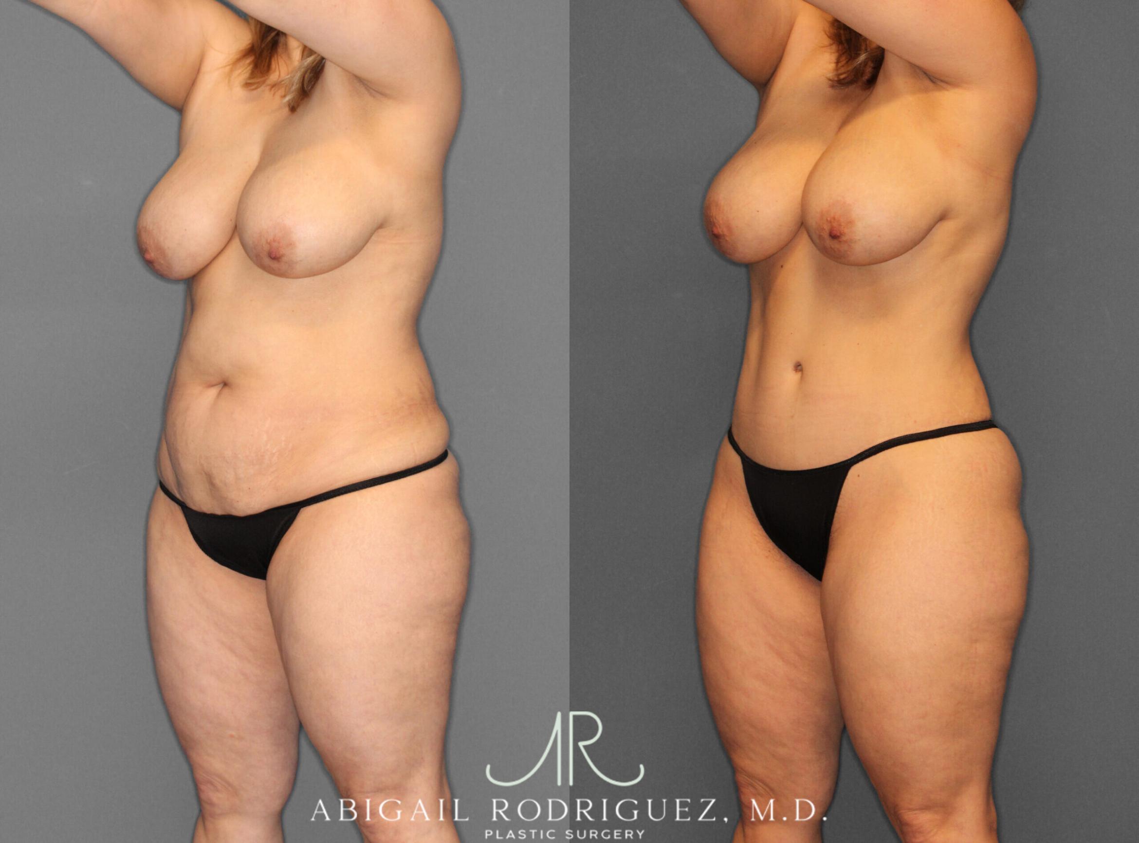 Before & After Fat Grafting Case 253931 View 2 View in Houston, TX