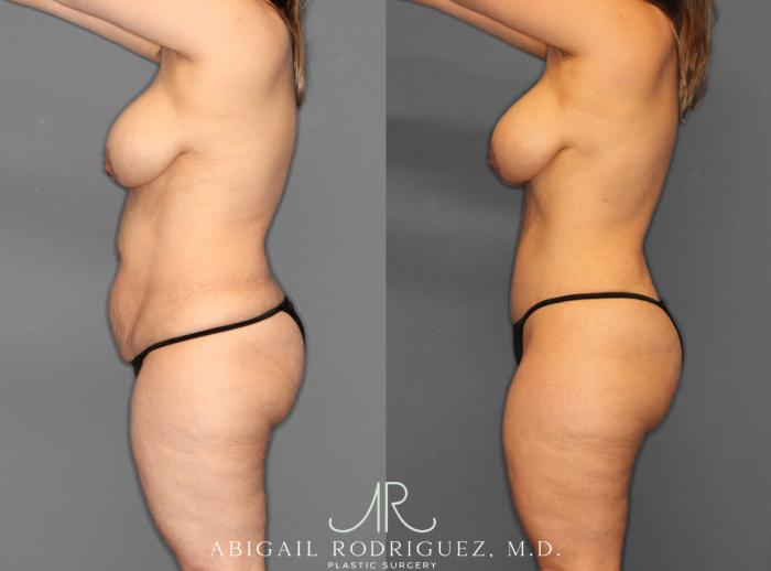 Before & After Fat Grafting Case 253931 View 3 View in Houston, TX