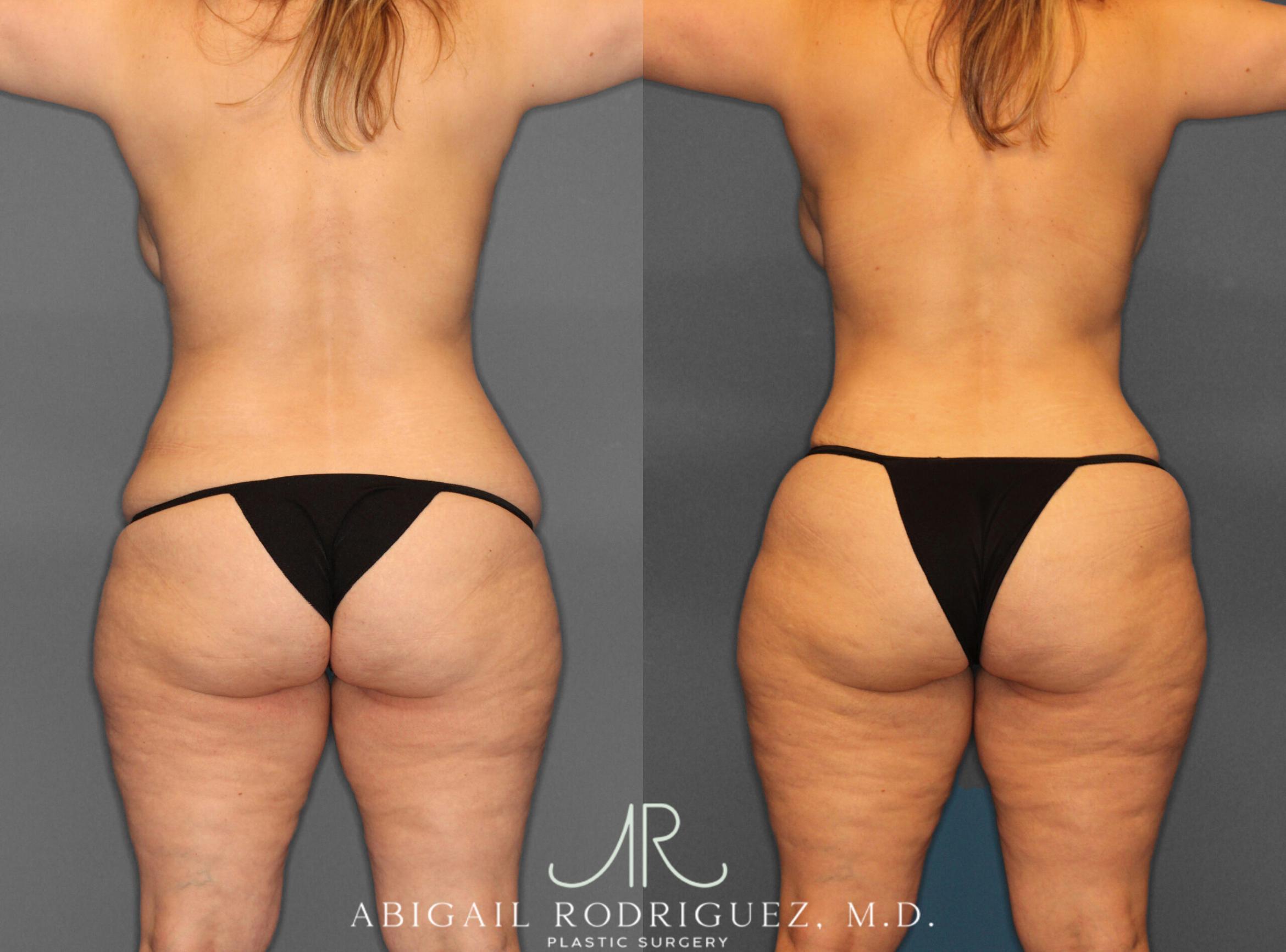 Before & After Fat Grafting Case 253931 View 4 View in Houston, TX