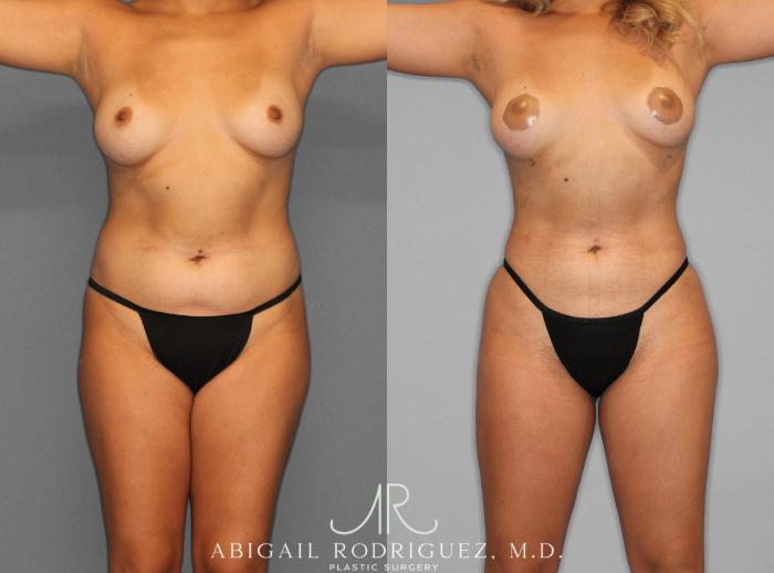 Before & After Fat Grafting Case 253937 View 1 View in Houston, TX