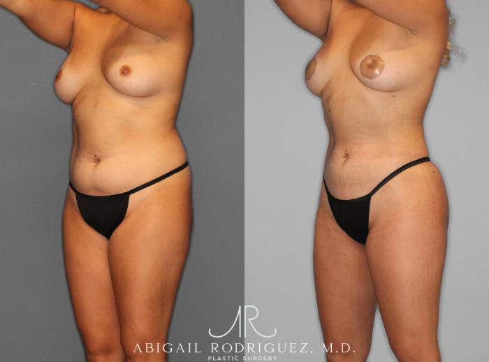 Before & After Fat Grafting Case 253937 View 2 View in Houston, TX