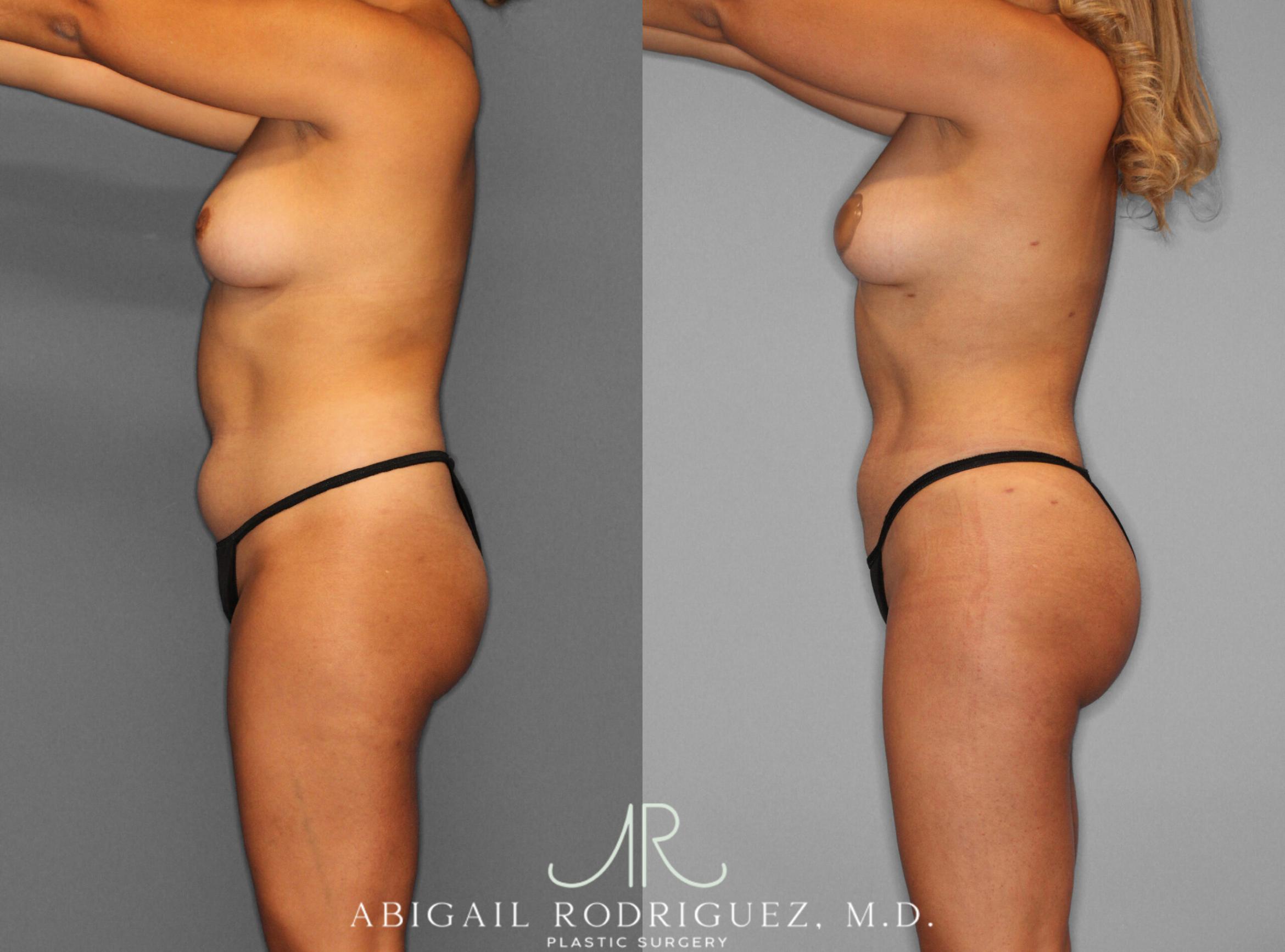 Before & After Fat Grafting Case 253937 View 3 View in Houston, TX