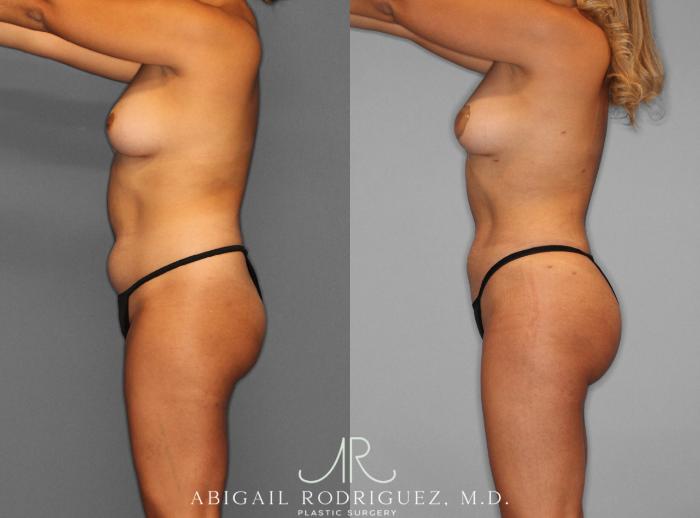 Before & After Fat Grafting Case 253937 View 3 View in Houston, TX